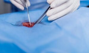 Treatment of varicose veins in hands