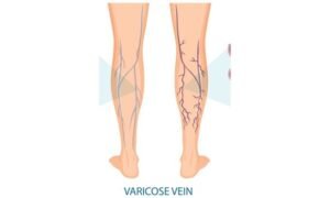 blue veins in legs