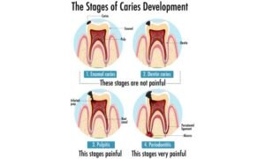 Stages of formation of cavities on front teeth