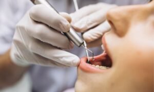 Treatment of cavities on front teeth