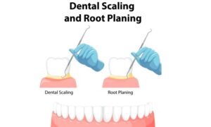 Treatment of gum recession