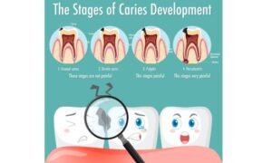 What Does a Cavity Look Like when it First Starts