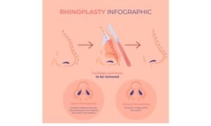 How Much does Rhinoplasty cost