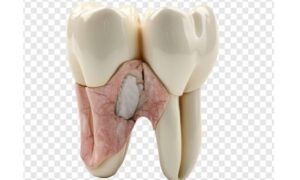 calcified tooth