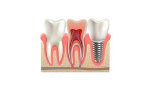 treatment of calcified tooth